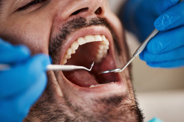 Best Emergency Dental Care for Broken or Chipped Teeth in Sparta, IL